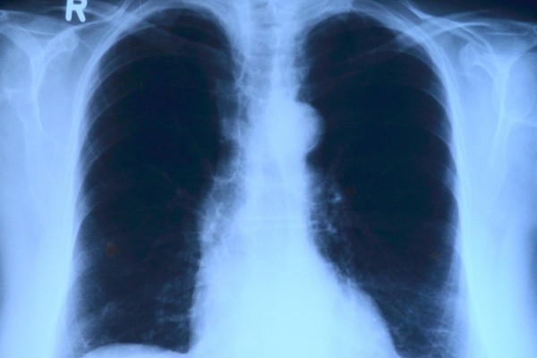 prześwietlenie płuc
